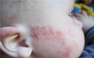 Az allergia okai gyermekeknél és felnőtteknél Hogyan lehet allergiás